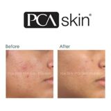 PCA Skin Blemish Control Bar  | Voor de Vette Huid