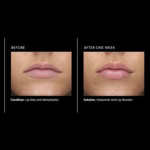 Droge lippen oplossen met PCa Skin Resultaten