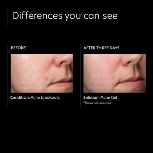 PCA Skin Acne Gel | Advanced Treatment